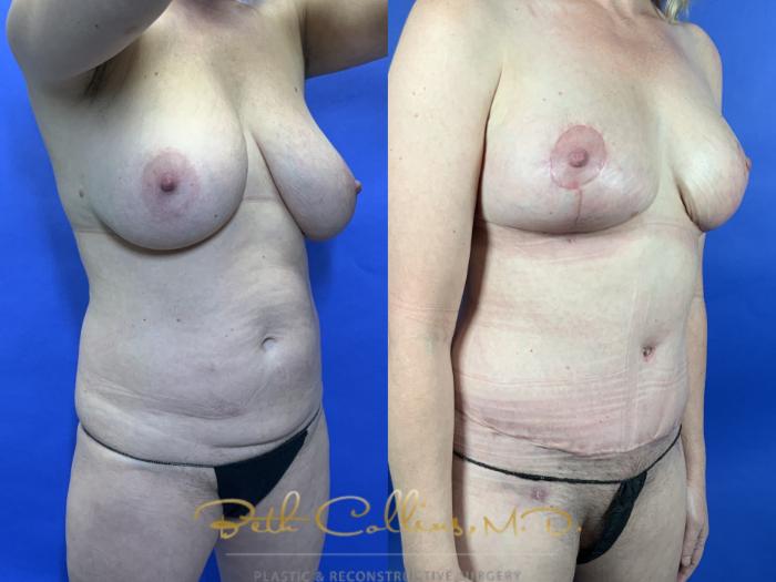 Mommy Makeover: With pregnancy comes stretching and ultimately wrinkling and sagging. This can present itself in many different ways. Most often, women seeking a mommy makeover want something done to their abdomen and breasts. This lovely lady was in great shape, but her breasts were deflated and she hated the texture of her skin on her abdomen. We did a breast reduction and a tummy tuck to achieve these nice results.