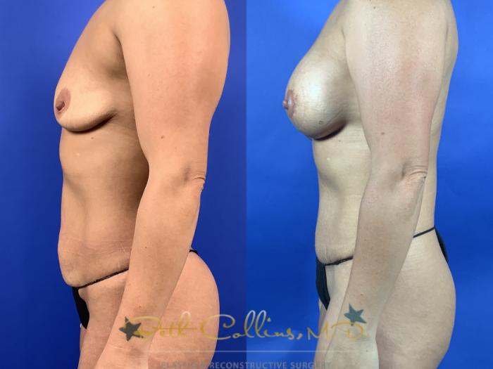 Mommy makeover: This patient had a tummy tuck with bilateral breast augmentation and periareolar mastopexy done one month ago. She is still in her early post operative period and will continue to improve with time.