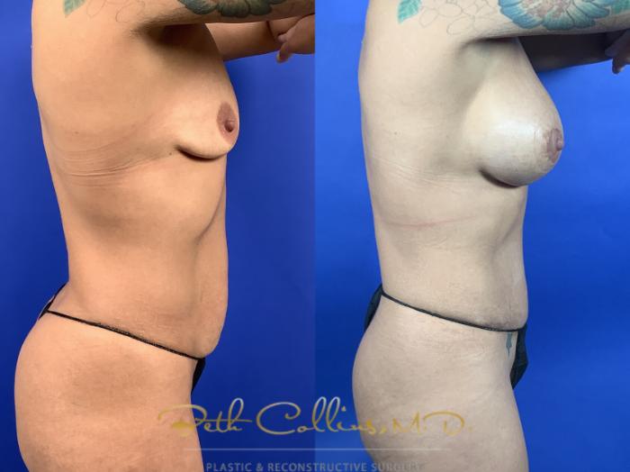 Mommy makeover: This patient had a tummy tuck with bilateral breast augmentation and periareolar mastopexy done one month ago. She is still in her early post operative period and will continue to improve with time.