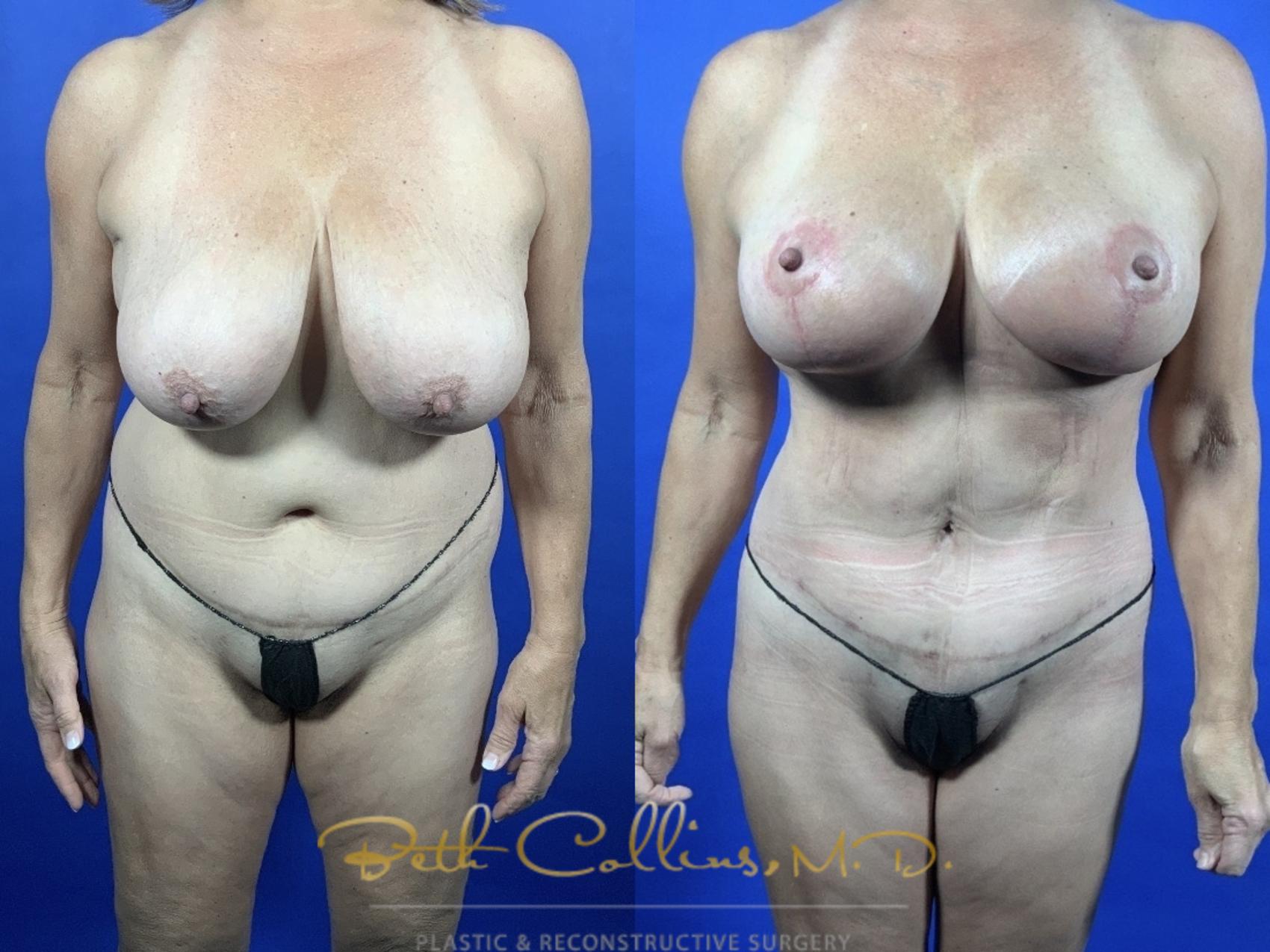 Abdominoplasty with lipo360 and breast reduction 