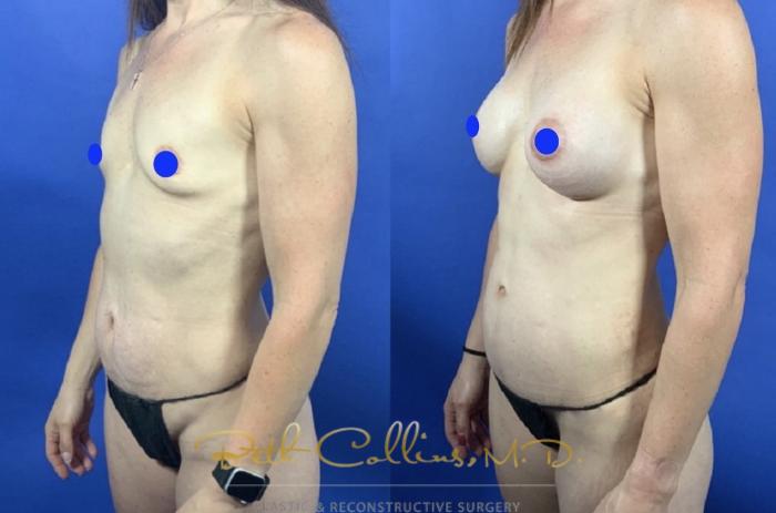Before & After Breast Augmentation Case 234 Left Oblique View in Guilford, CT