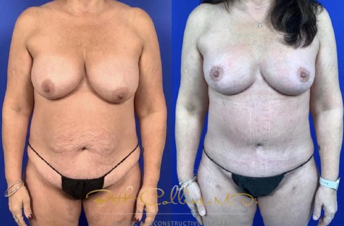 Before & After Breast Lift Case 235 Front View in Guilford, CT