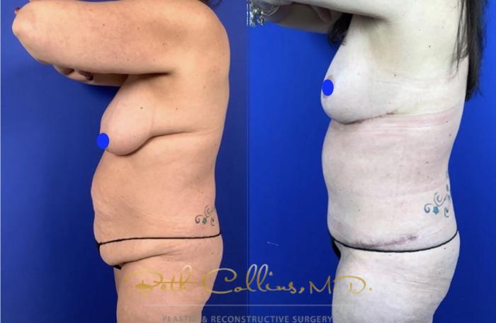 Before & After Breast Lift Case 235 Left Side View in Guilford, CT