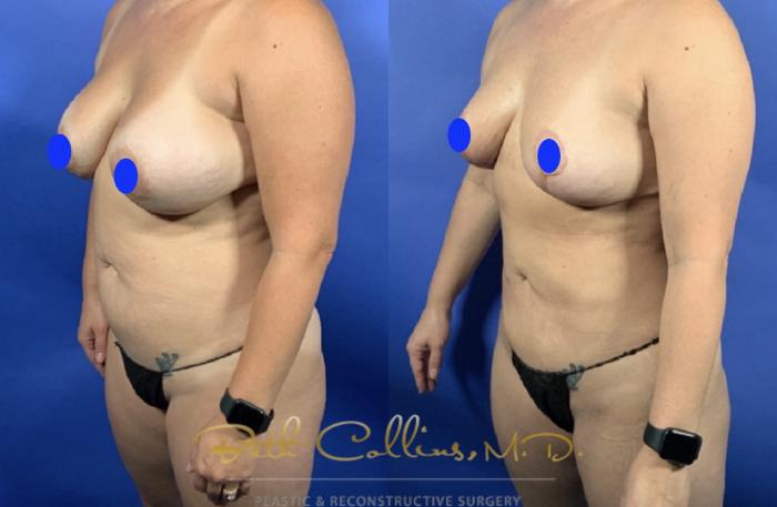 Before & After Breast Reduction Case 237 Left Oblique View in Guilford, CT