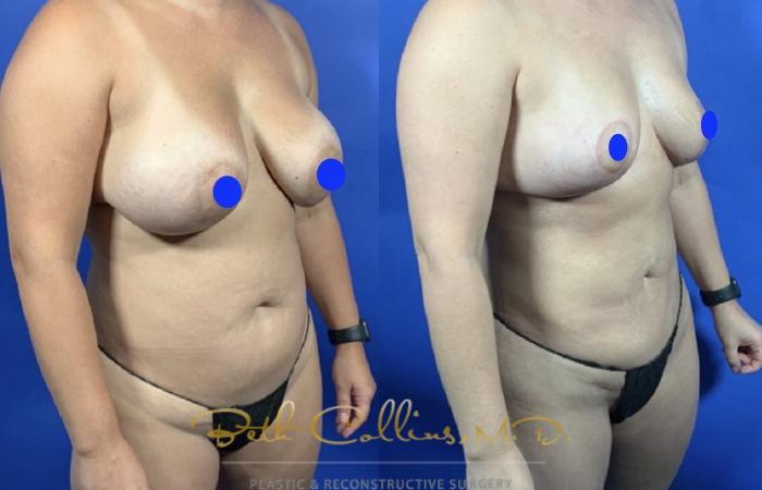 Before & After Breast Reduction Case 237 Right Oblique View in Guilford, CT
