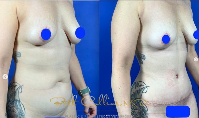 Before & After Mommy Makeover Case 279 Right Oblique View in Guilford, CT