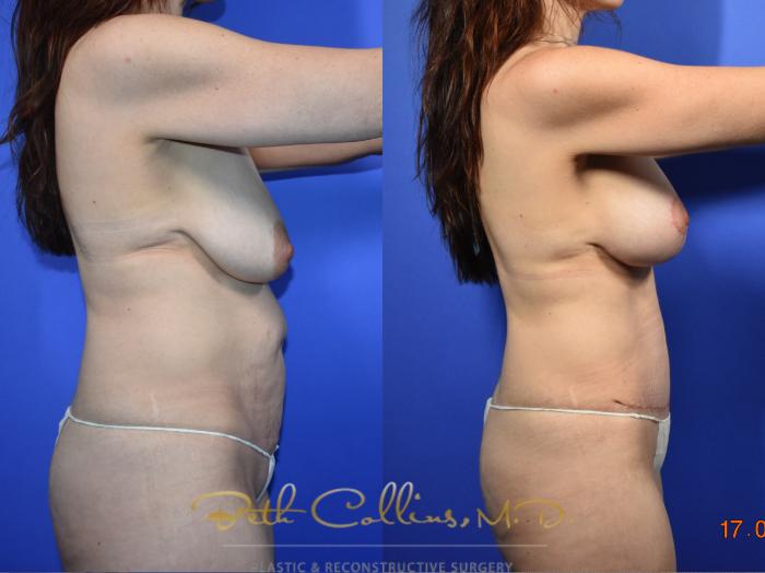 This is an early post op of a Mommy Makeover. This patient had a tummy tuck and breast augmentation with mastopexy. She is just one month out from her surgery and in time, her scars will fade and become much less visible. She will be able to wear a bikini and nobody will be able to see her scars. 
