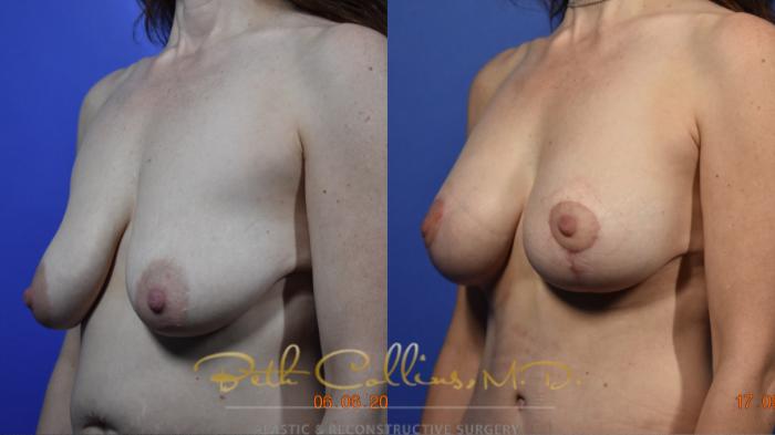 This is an early post op of a Mommy Makeover. This patient had a tummy tuck and breast augmentation with mastopexy. She is just one month out from her surgery and in time, her scars will fade and become much less visible. She will be able to wear a bikini and nobody will be able to see her scars. 