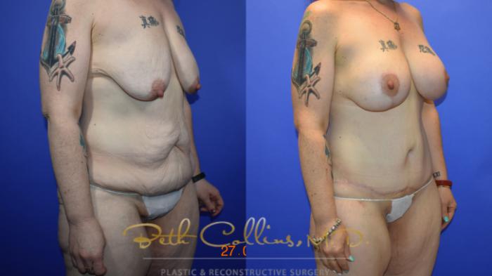 Before & After Breast Lift Case 92 View #2 View in Guilford, CT