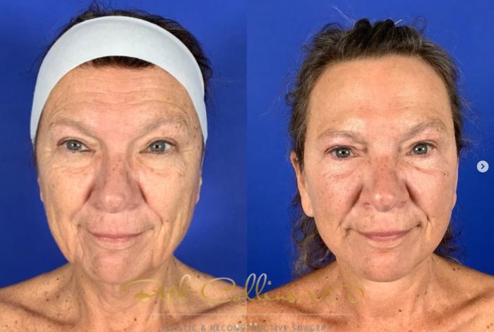 Before & After Neck Lift Case 272 Front View in Guilford, CT