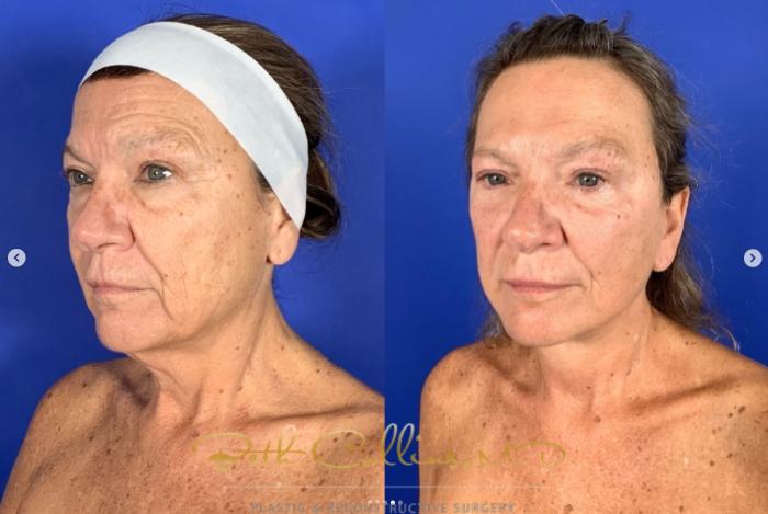 Before & After Neck Lift Case 272 Left Oblique View in Guilford, CT