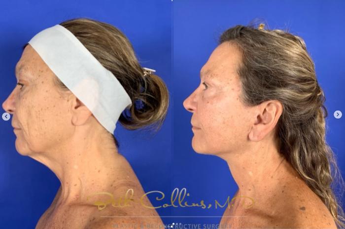 Before & After Neck Lift Case 272 Left Side View in Guilford, CT