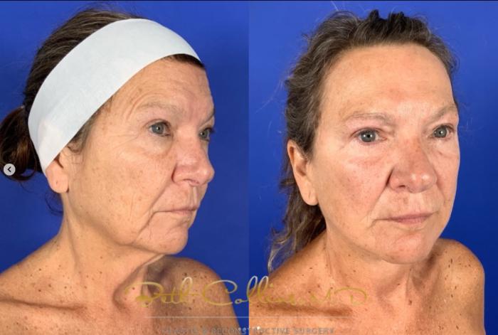 Before & After Neck Lift Case 272 Right Oblique View in Guilford, CT