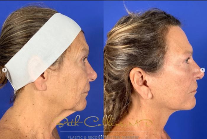 Before & After Facelift Case 272 Right Side View in Guilford, CT