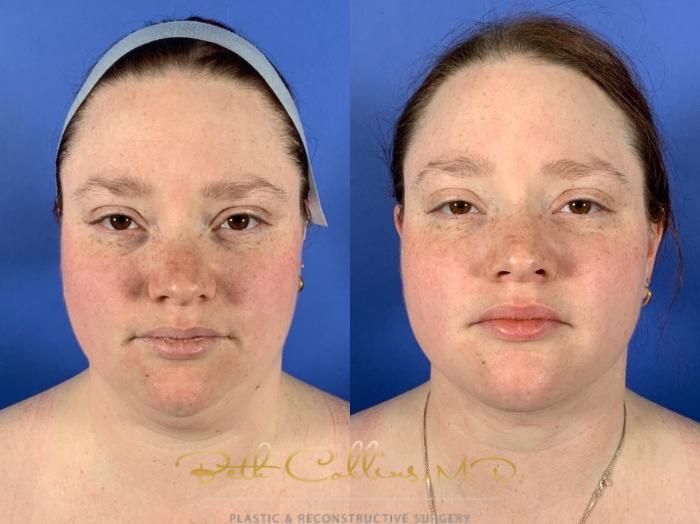 Neck Liposuction: Some people have excess fat in the subcutaneous compartment of their neck and good skin quality. These people are the best candidates for neck liposuction. Other options can be coolsculpting or Kybella, but these options are less predictable and effective than neck liposuction which is most often a "one and done" procedure.
