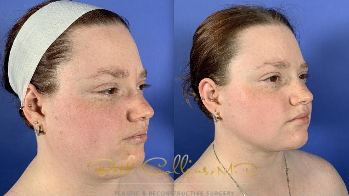 Neck liposuction: Some people have excess fat in the subcutaneous compartment of their neck and good skin quality. These people are the best candidates for neck liposuction. Other options can be coolsculpting or Kybella, but these options are less predictable and effective than neck liposuction which is most often a "one and done" procedure.