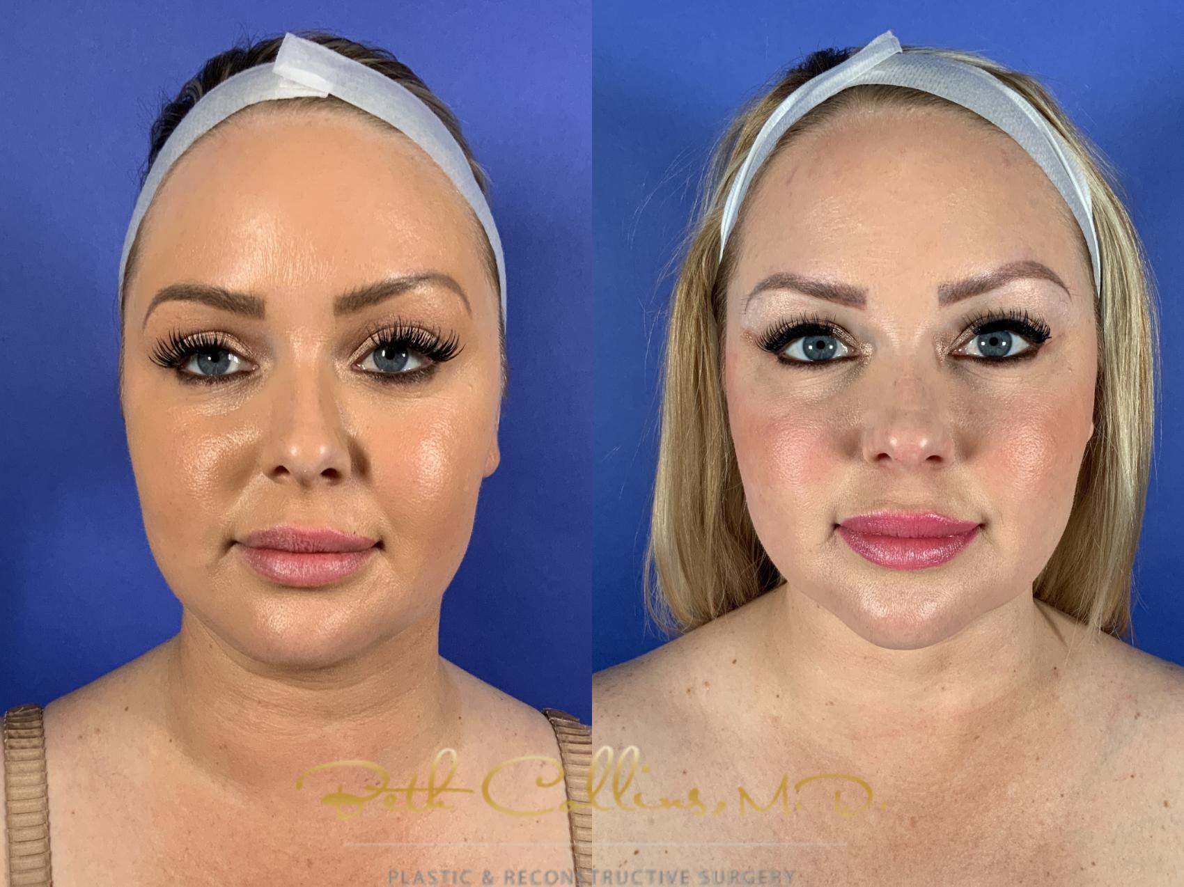 Chin and Neck Liposuction