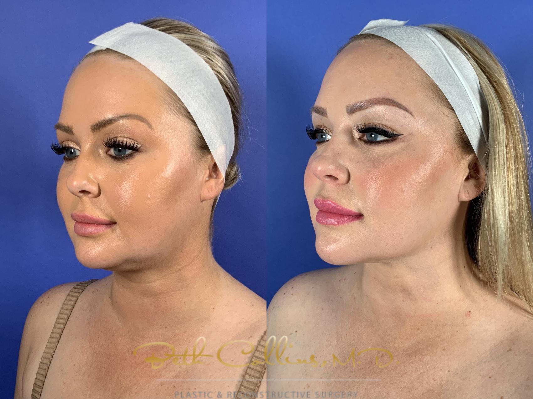 Liposuction of chin and neck