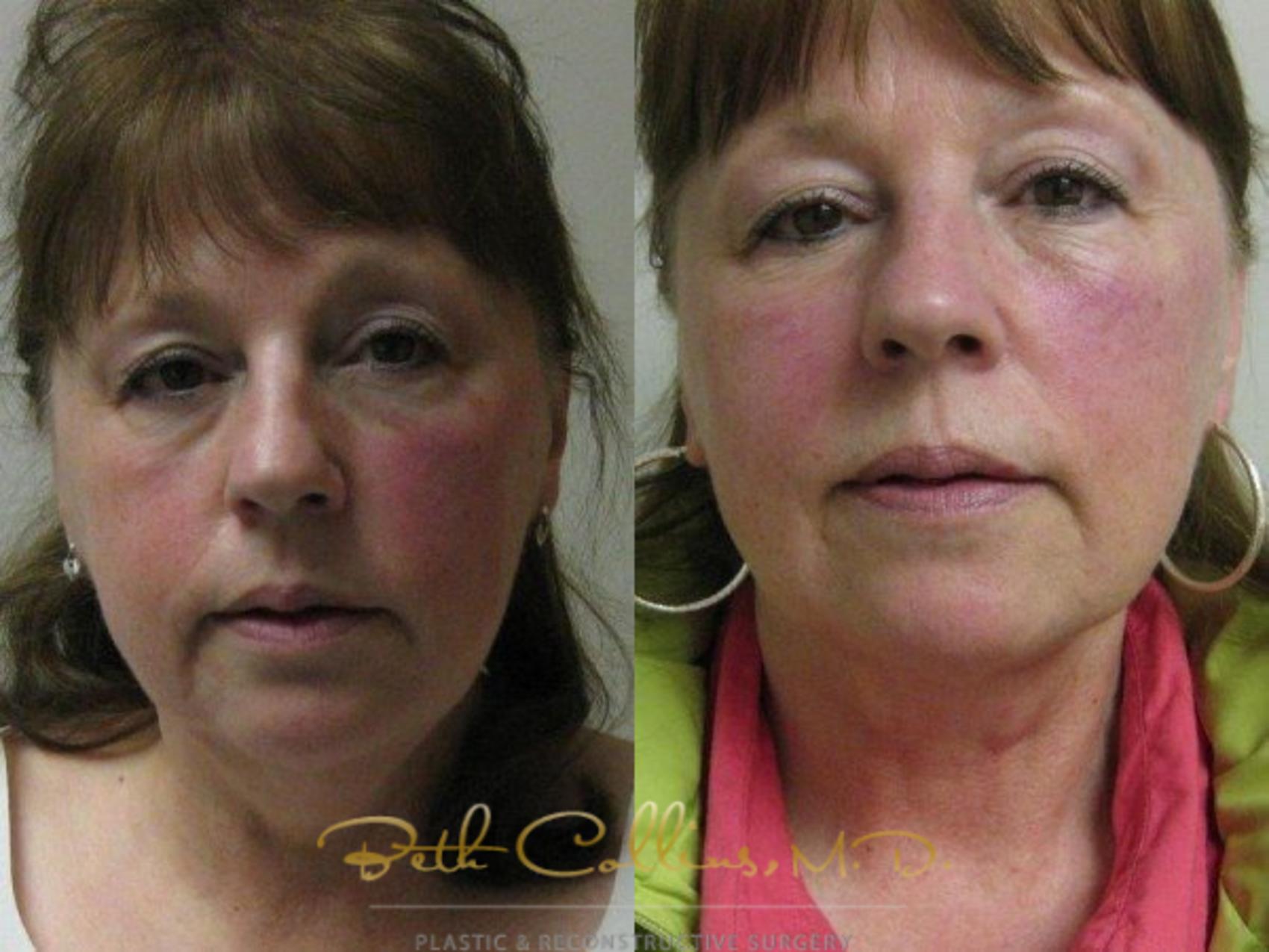Before & After Neck Liposuction Case 78 View #1 View in Guilford, CT