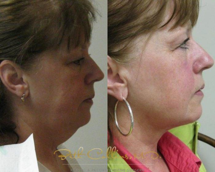 Before & After Neck Liposuction Case 78 View #2 View in Guilford, CT