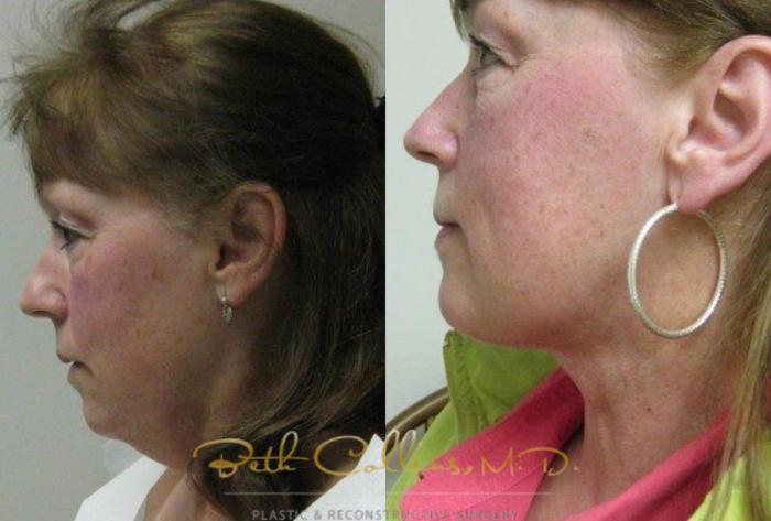 Before & After Neck Liposuction Case 78 View #3 View in Guilford, CT