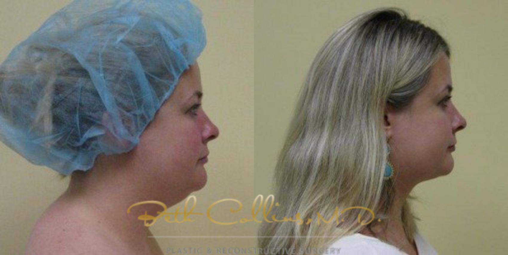 Before & After Neck Liposuction Case 79 View #1 View in Guilford, CT