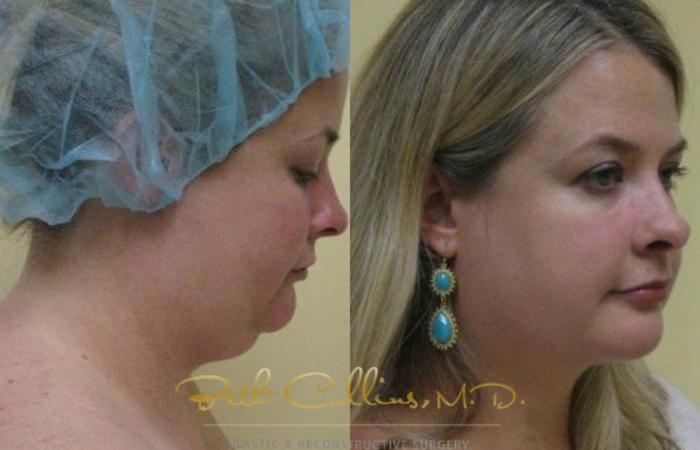 Before & After Neck Liposuction Case 79 View #2 View in Guilford, CT