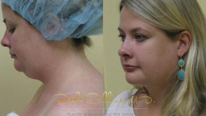 Before & After Neck Liposuction Case 79 View #4 View in Guilford, CT