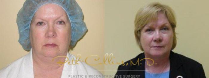 Before & After Neck Liposuction Case 80 View #1 View in Guilford, CT