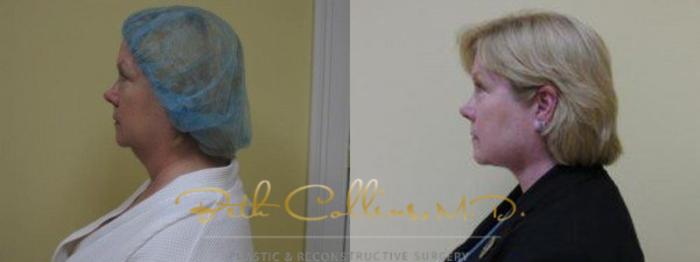 Before & After Neck Liposuction Case 80 View #2 View in Guilford, CT