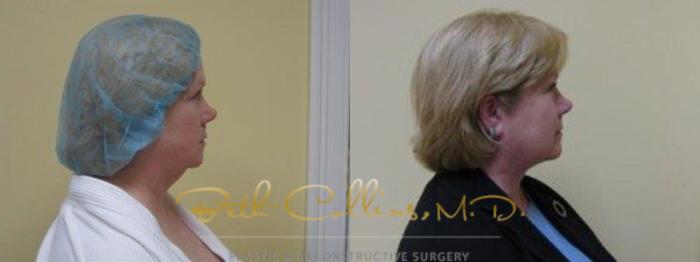 Before & After Neck Liposuction Case 80 View #3 View in Guilford, CT