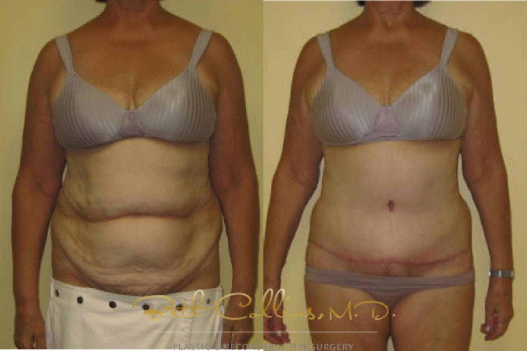 Before & After Tummy Tuck Case 1 View #1 View in Guilford, CT