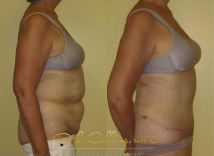 Before & After Tummy Tuck Case 1 View #2 View in Guilford, CT