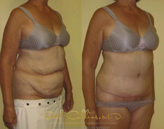 Before & After Tummy Tuck Case 1 View #3 View in Guilford, CT