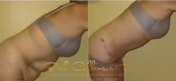 Before & After Tummy Tuck Case 1 View #4 View in Guilford, CT