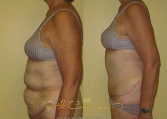 Before & After Tummy Tuck Case 1 View #5 View in Guilford, CT
