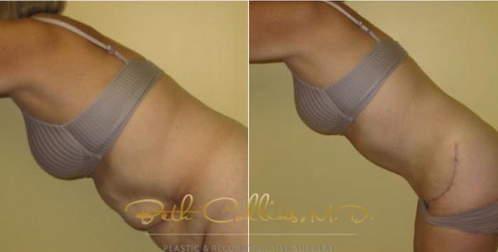 Before & After Tummy Tuck Case 1 View #6 View in Guilford, CT