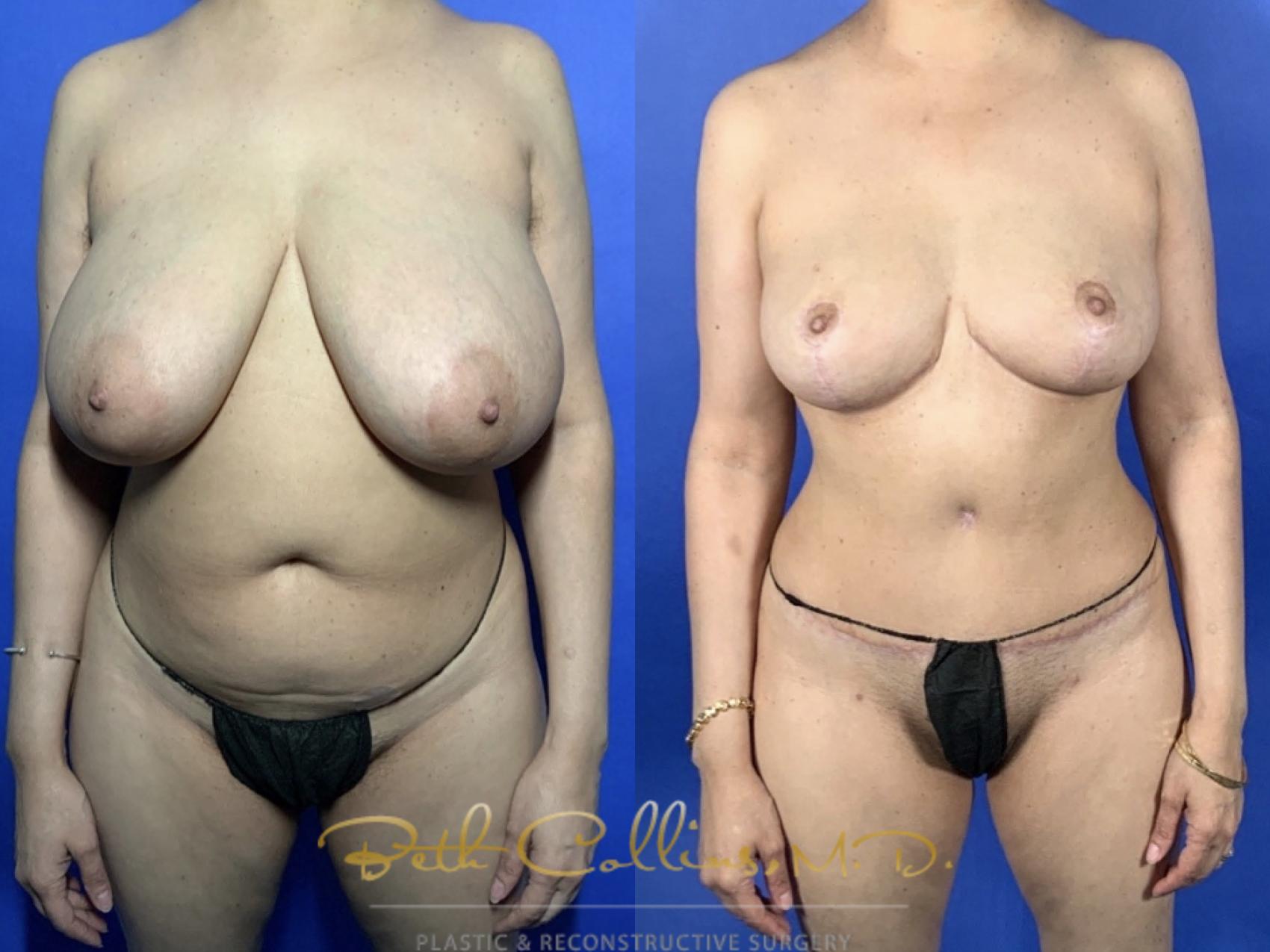Body Contouring: This petite lady was bothered by her large breasts and excess fat in her abdomen and trunk. She had a bilateral breast reduction and abdominoplasty with 360 degree liposuction. This narrowed her waist, slimmed her back and flattened her abdomen while reducing the size of her breasts and lifting them at the same time.