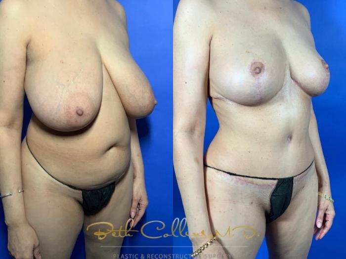 Body ContouringBody Contouring: This petite lady was bothered by her large breasts and excess fat in her abdomen and trunk. She had a bilateral breast reduction and abdominoplasty with 360 degree liposuction. This narrowed her waist, slimmed her back and flattened her abdomen while reducing the size of her breasts and lifting them at the same time.