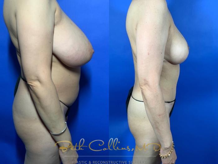 Body Contouring: This petite lady was bothered by her large breasts and excess fat in her abdomen and trunk. She had a bilateral breast reduction and abdominoplasty with 360 degree liposuction. This narrowed her waist, slimmed her back and flattened her abdomen while reducing the size of her breasts and lifting them at the same time.
