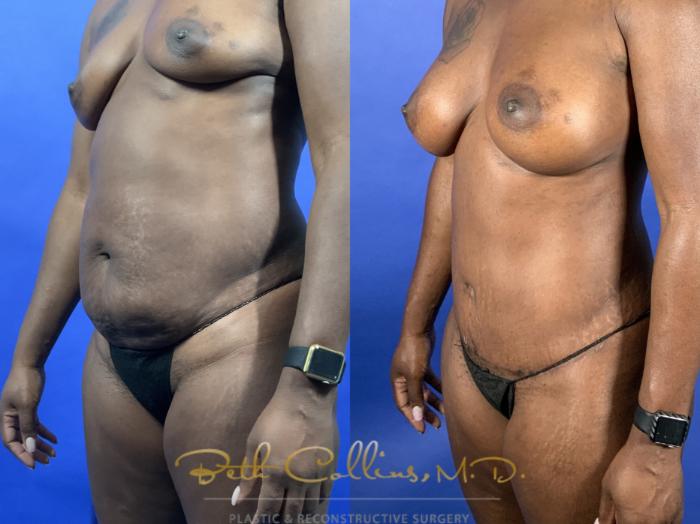 Mommy Makeover: With pregnancy comes stretching and ultimately wrinkling and sagging. This can present itself in many different ways. Most often, women seeking a mommy makeover want something done to their abdomen and breasts. This lovely lady was in great shape, but her breasts were deflated and she hated the texture of her skin on her abdomen. We did breast augmentation with gel implants and a tummy tuck to achieve these nice results.