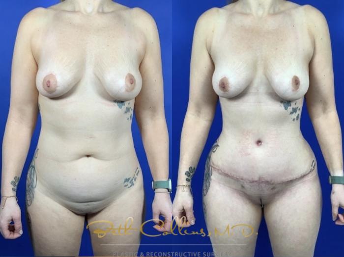 Abdominoplasty with flank liposuction