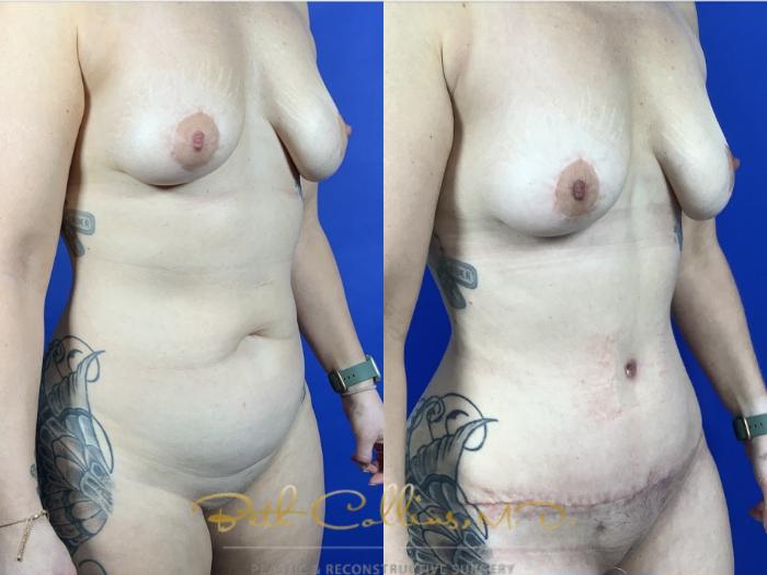 Abdominoplasty with flank liposuction