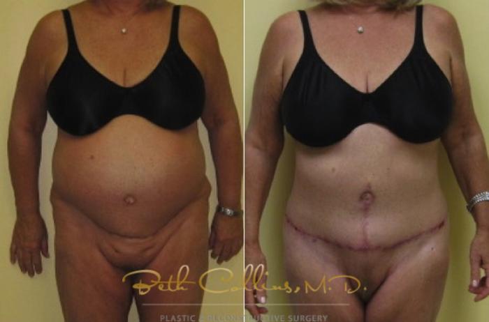 Before & After Tummy Tuck Case 2 View #1 View in Guilford, CT