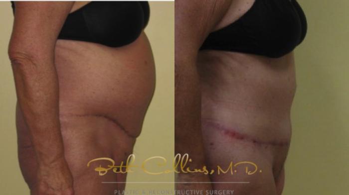 Before & After Tummy Tuck Case 2 View #2 View in Guilford, CT