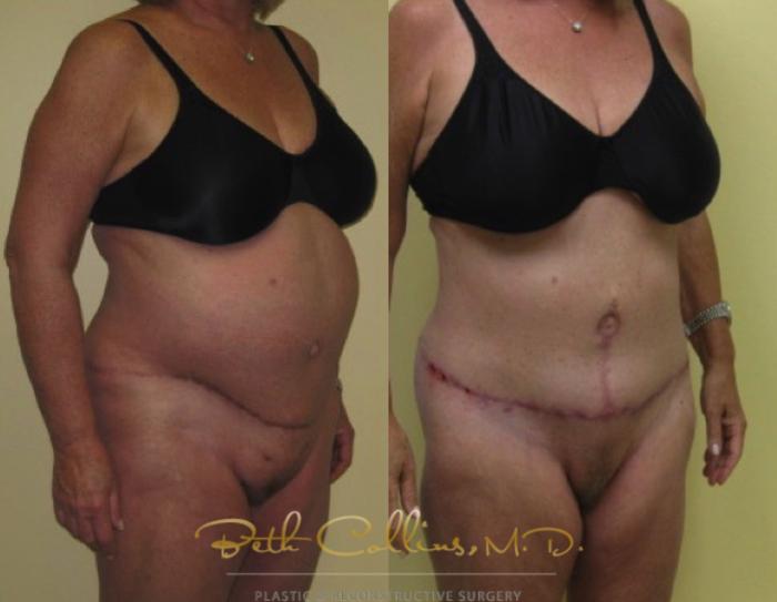 Before & After Tummy Tuck Case 2 View #3 View in Guilford, CT