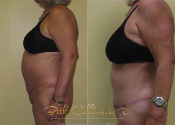 Before & After Tummy Tuck Case 2 View #4 View in Guilford, CT