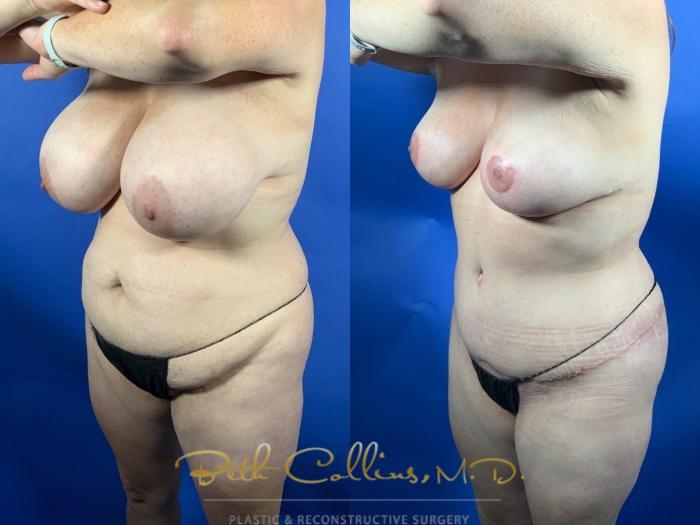 Abdominoplasty with lipo360 and breast reduction 