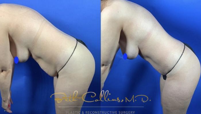 Before & After Tummy Tuck Case 236 Left Side View in Guilford, CT