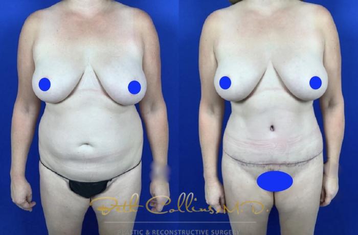 Before & After Liposuction Case 238 Front View in Guilford, CT